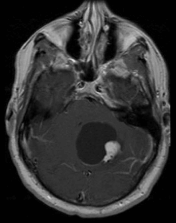 Το αιμαγγειοβλάστωμα - hemangioblastoma - Νόσος Von Hippel Lindau