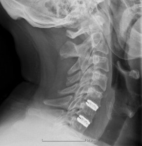 ARTIFICIAL CERVICAL DISC